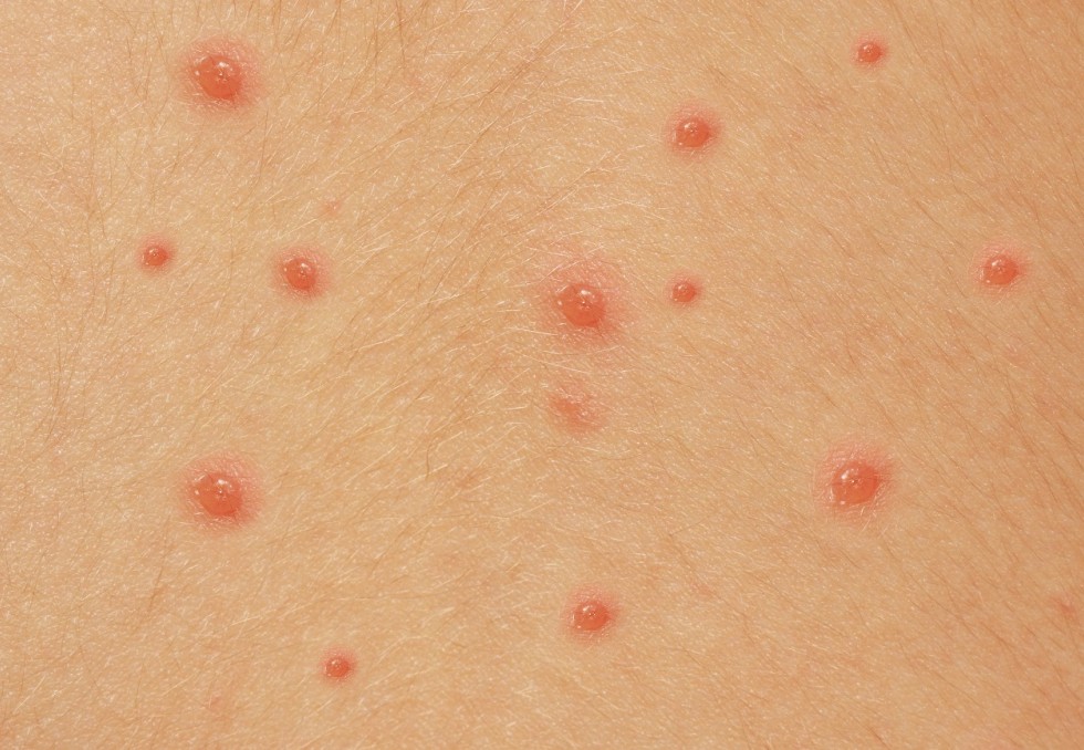 Varicelle
