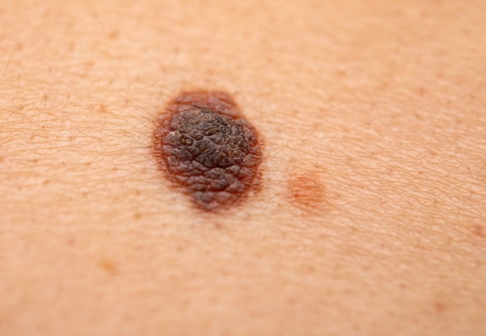 cancer de la peau