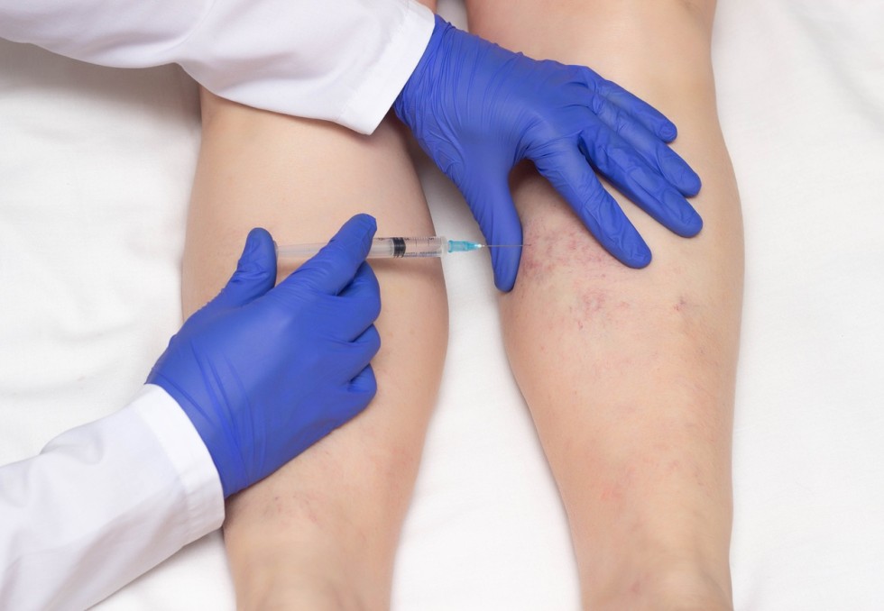 varices