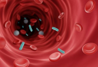 sepsis
