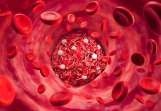 Thrombose