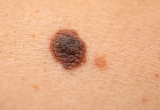 cancer de la peau